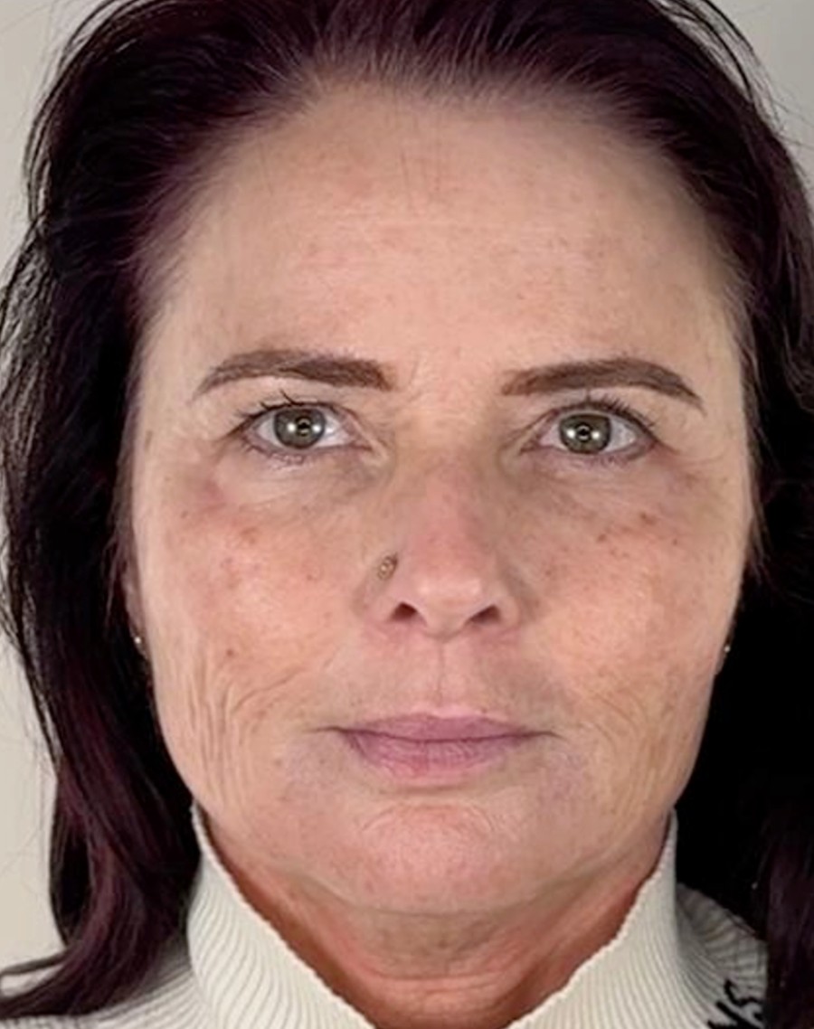 Dermal filler, after treatment
