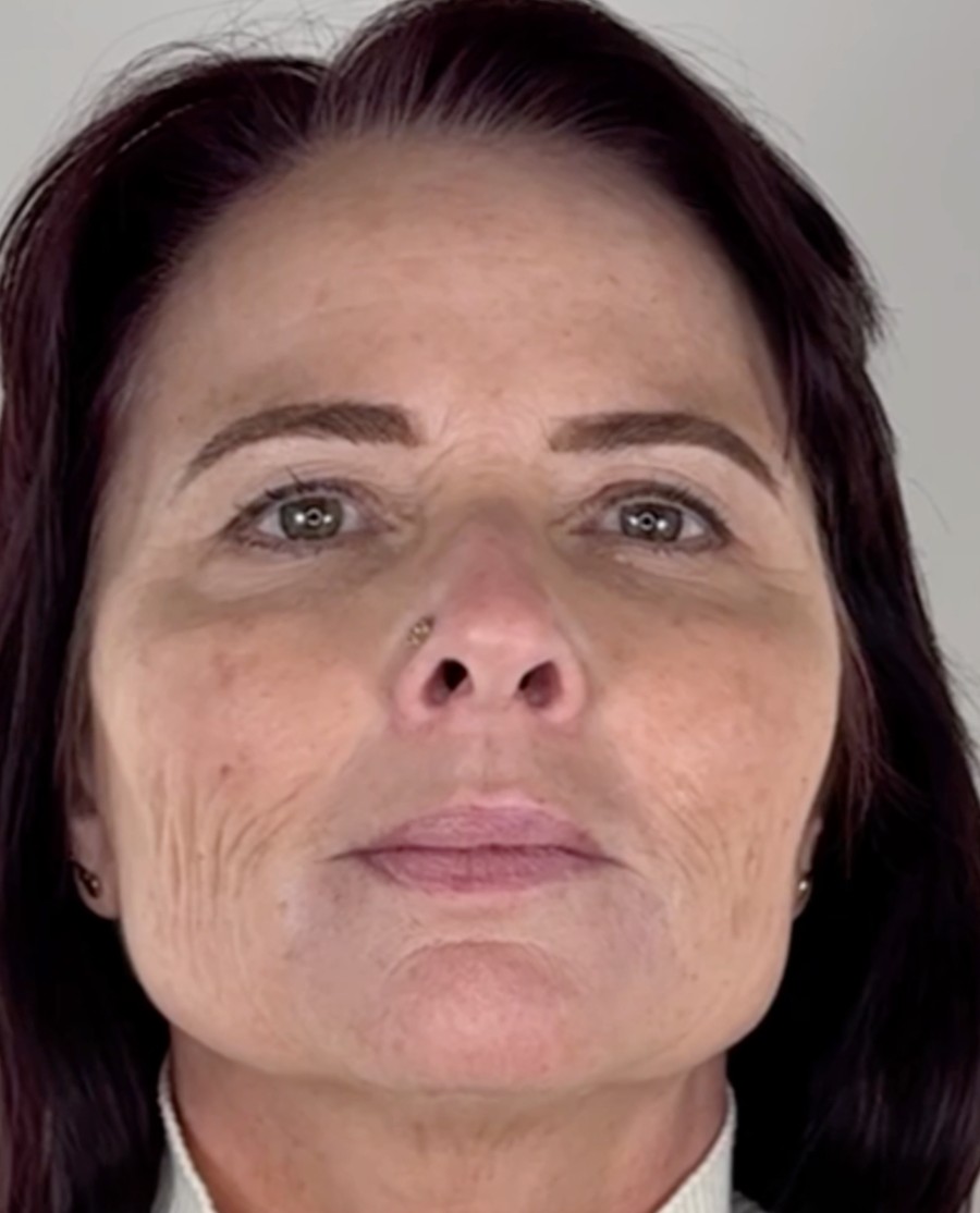 Dermal filler, before treatment