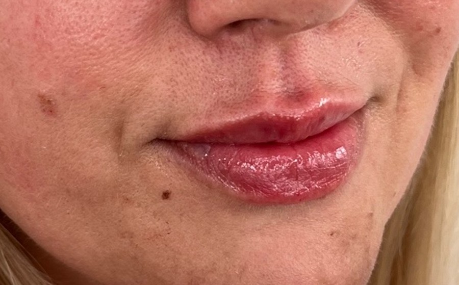 Lip enhancement, after treatment