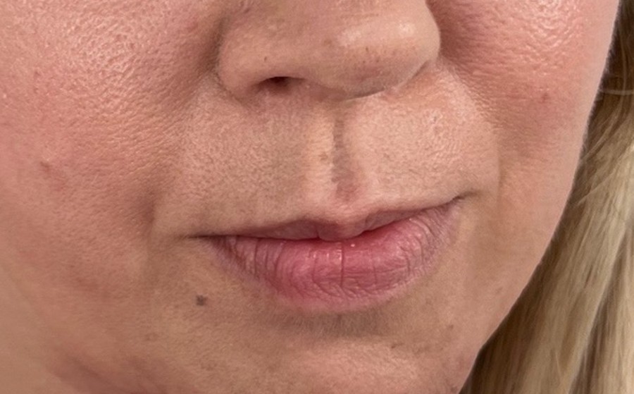 Lip enhancement, before treatment