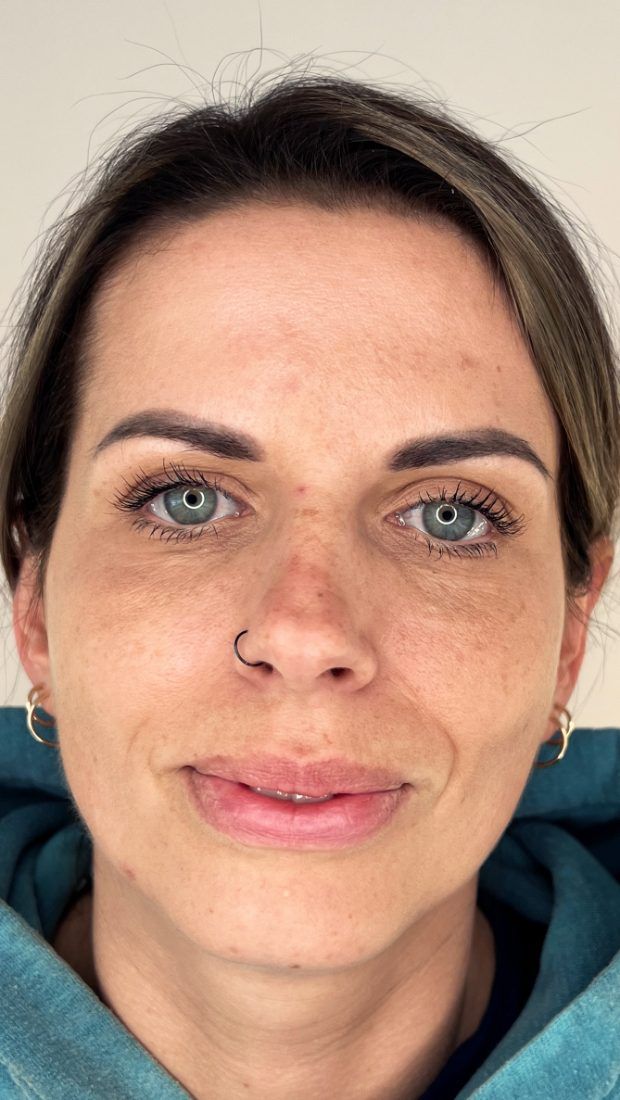 Before treatment