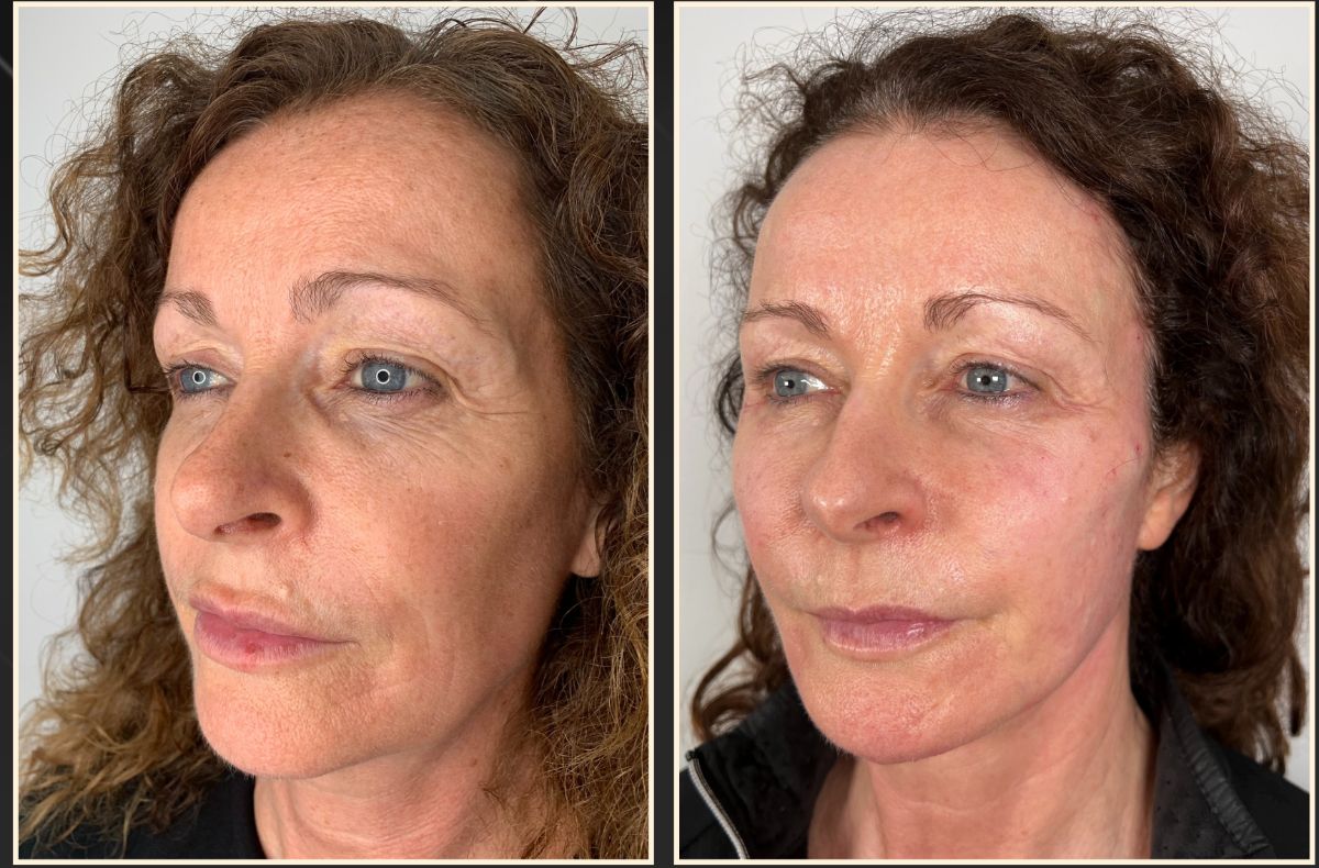 HIFU, dermal filler, TCA, expression lines and PDO threads result, before