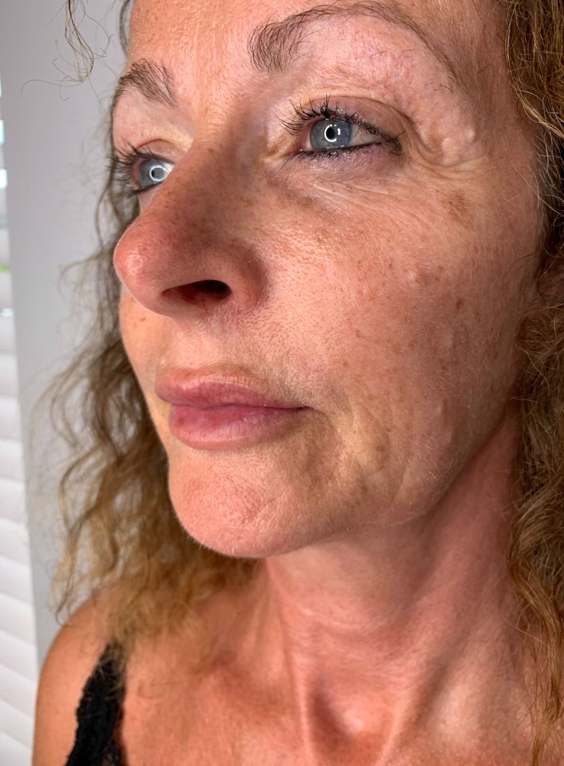 Before treatment