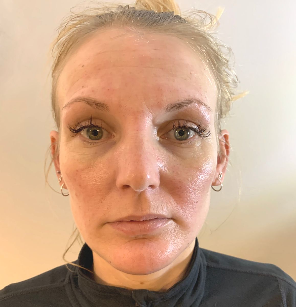 Before treatment