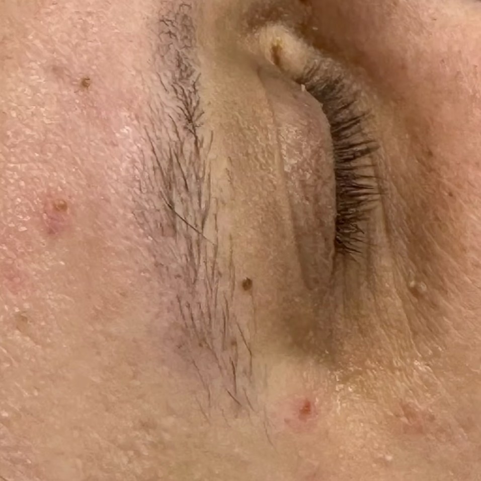 After treatment