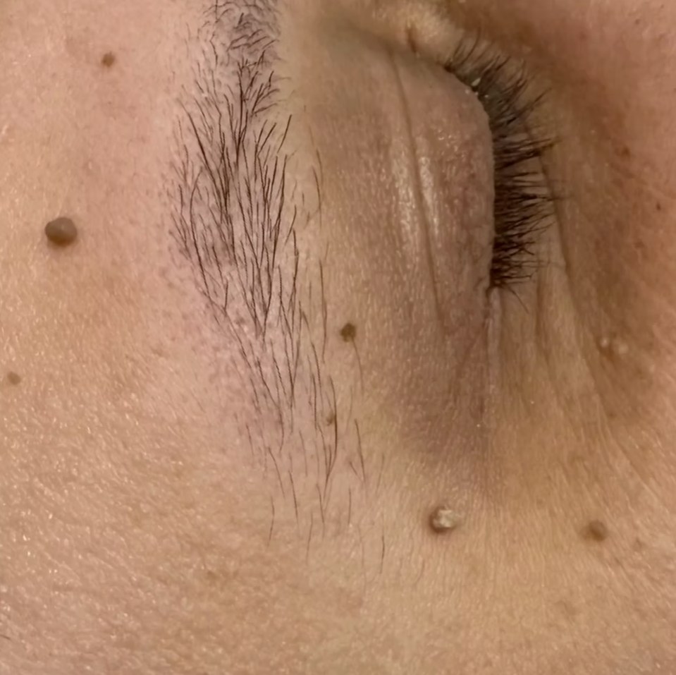 Before treatment