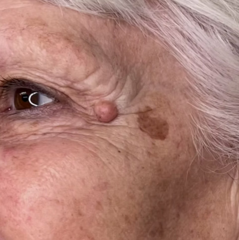 Before treatment