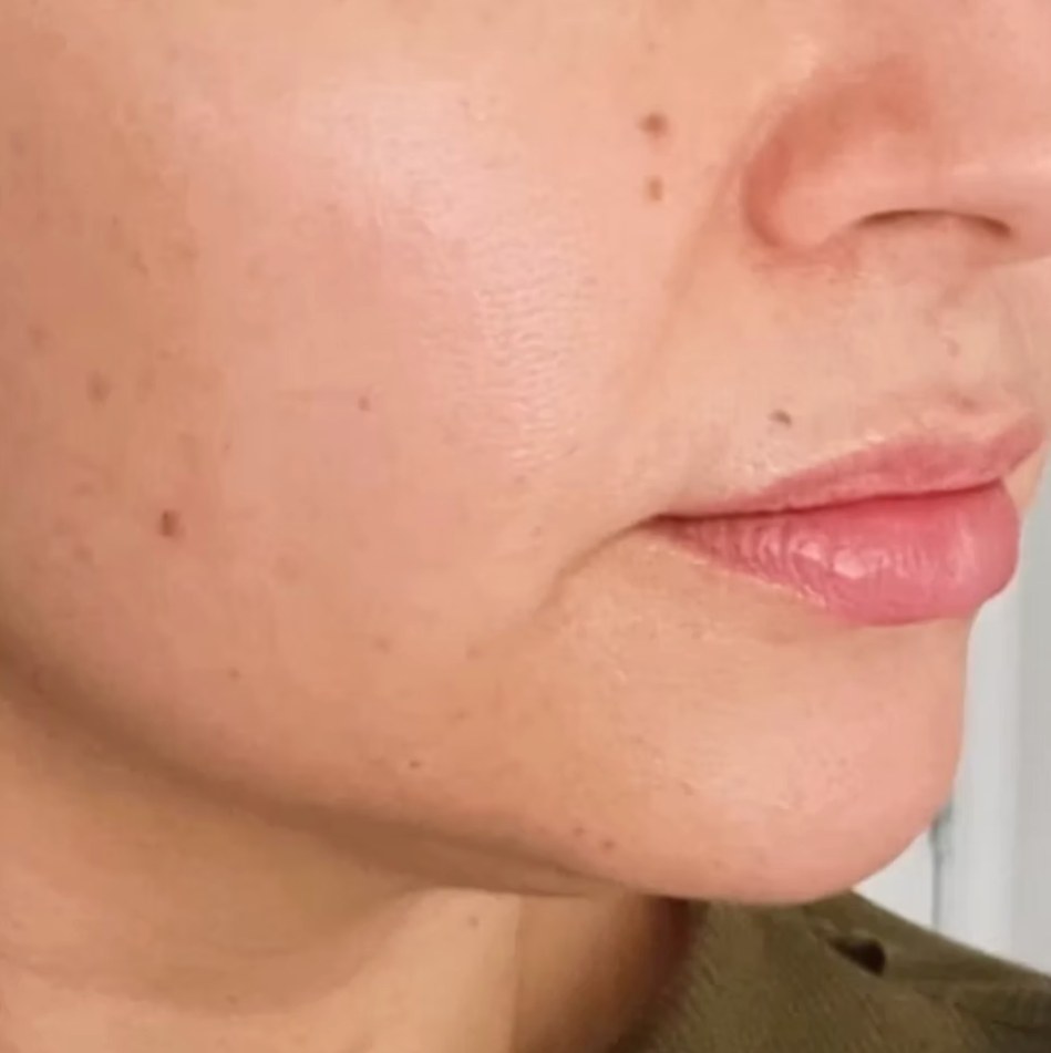 After treatment