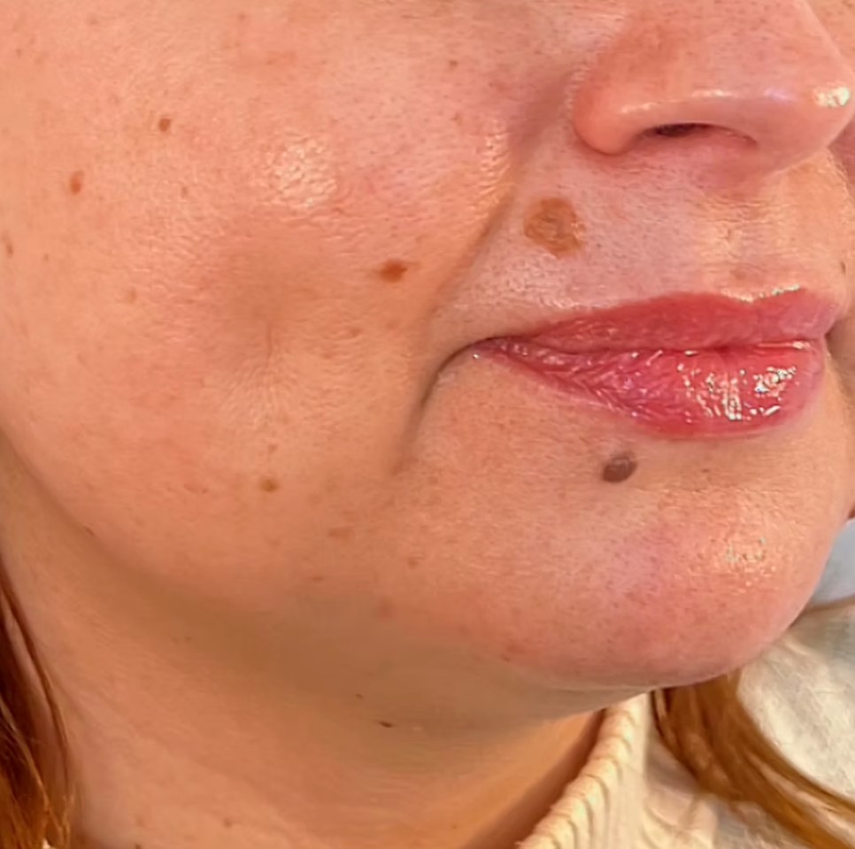Before treatment
