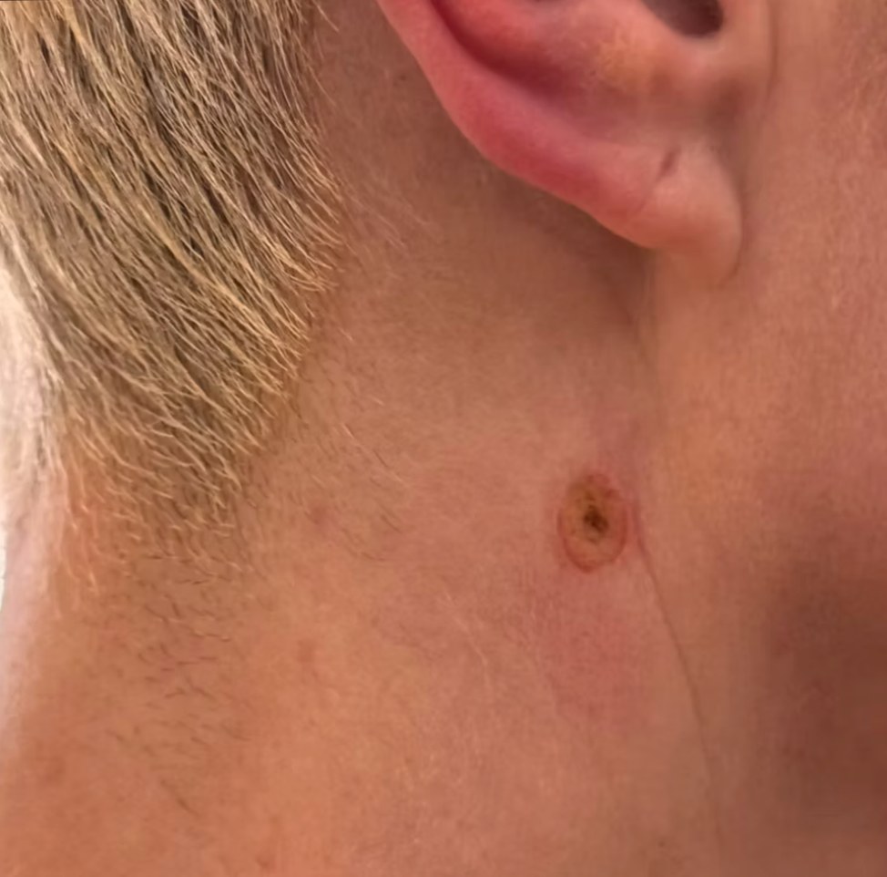After treatment