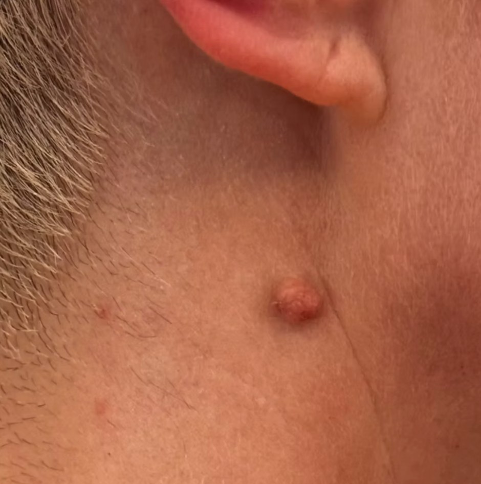Before treatment