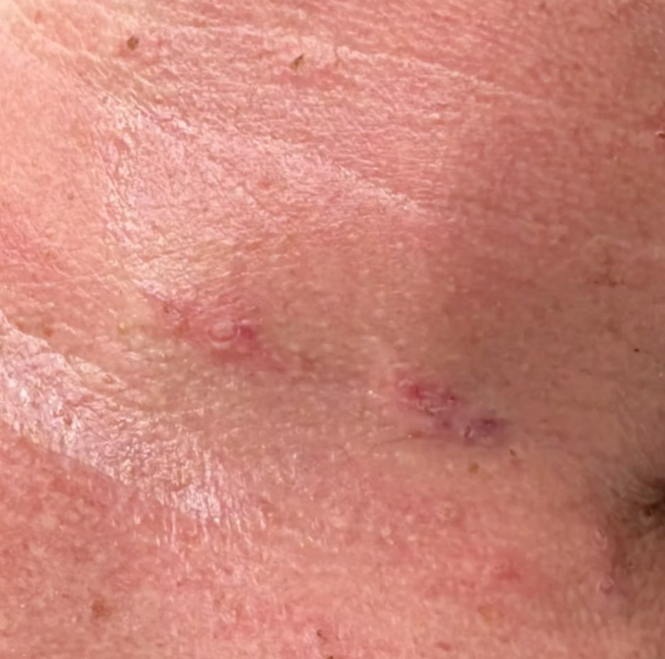 After treatment