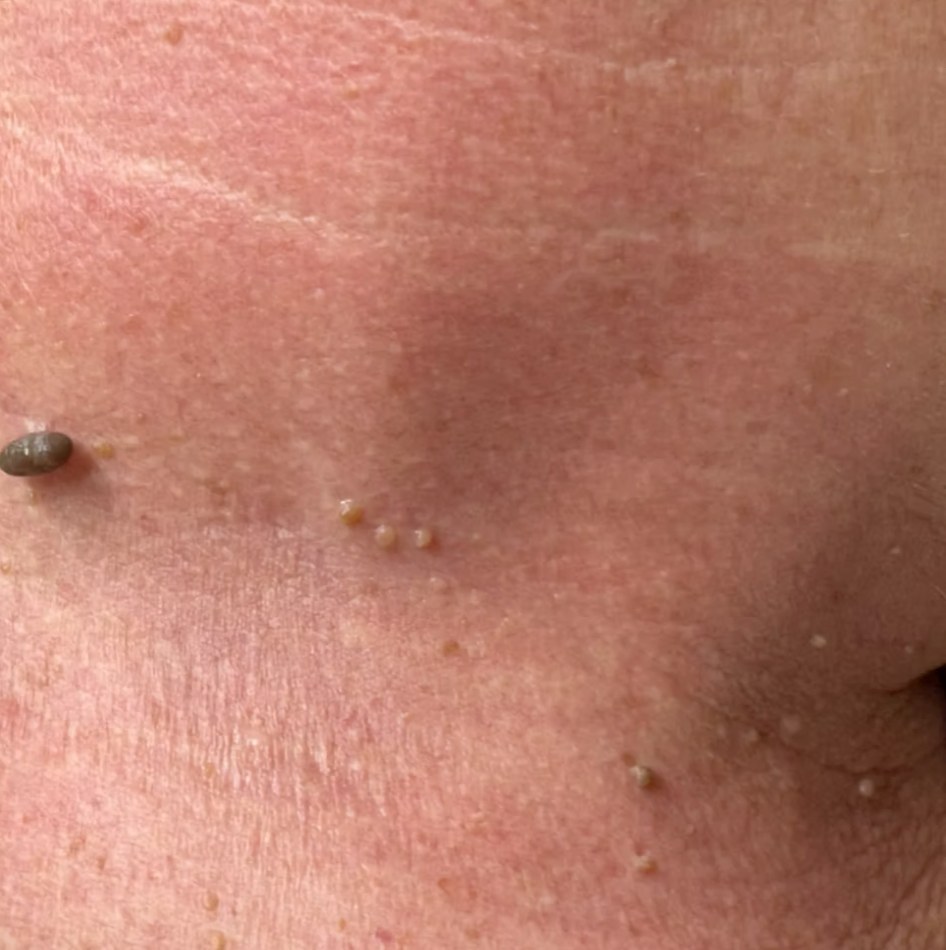Before treatment