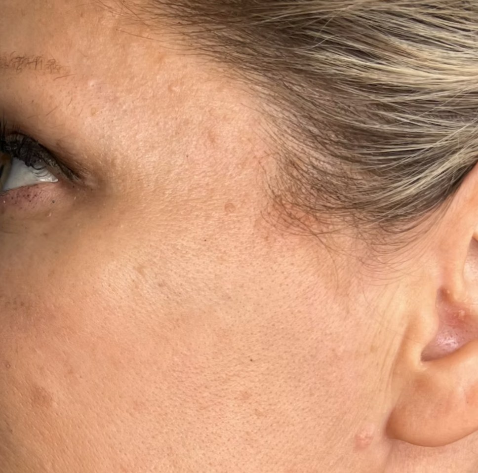 After treatment