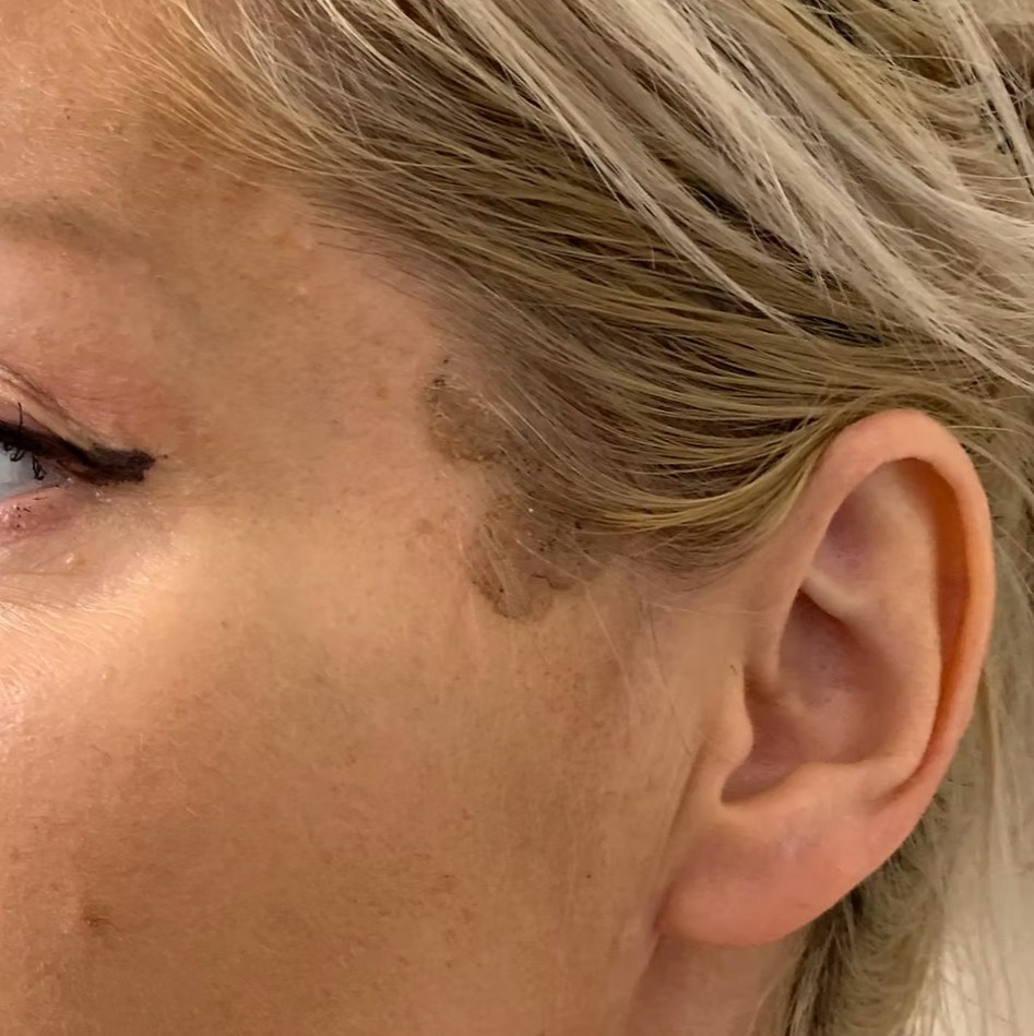 Before treatment
