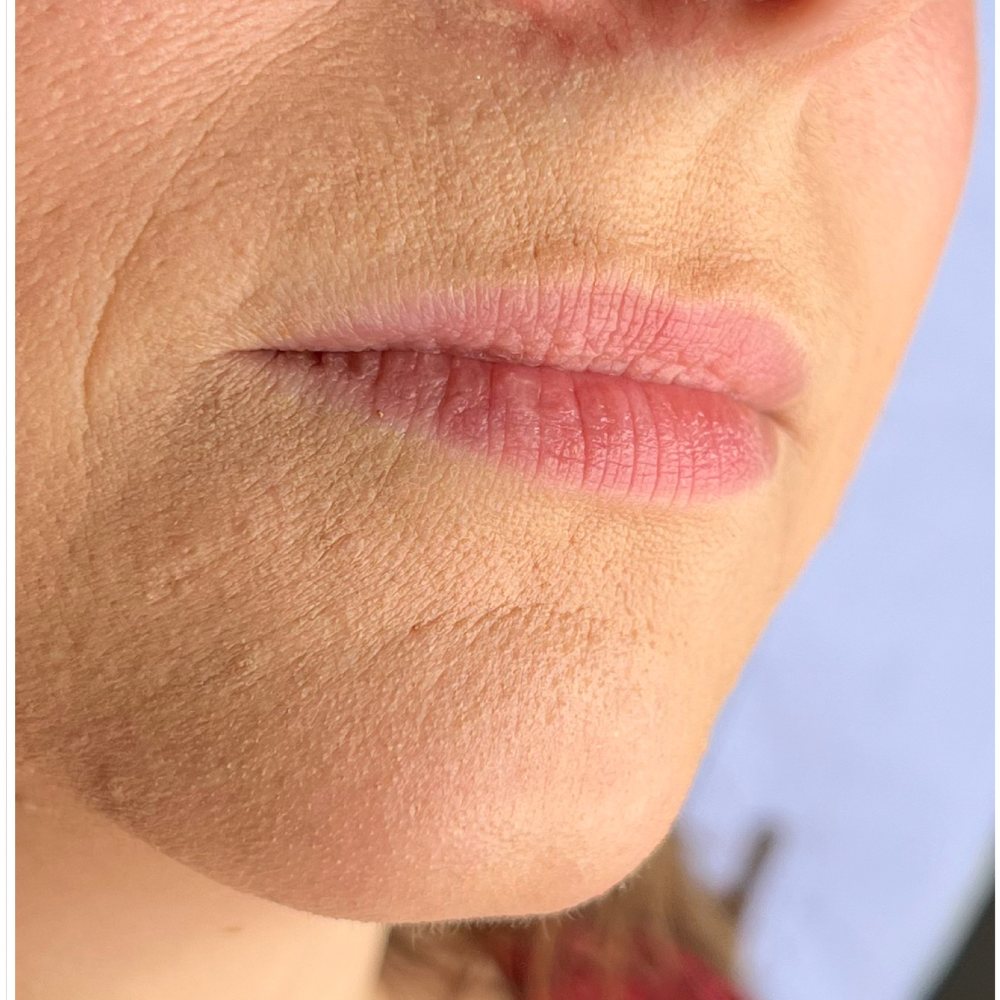 Before treatment