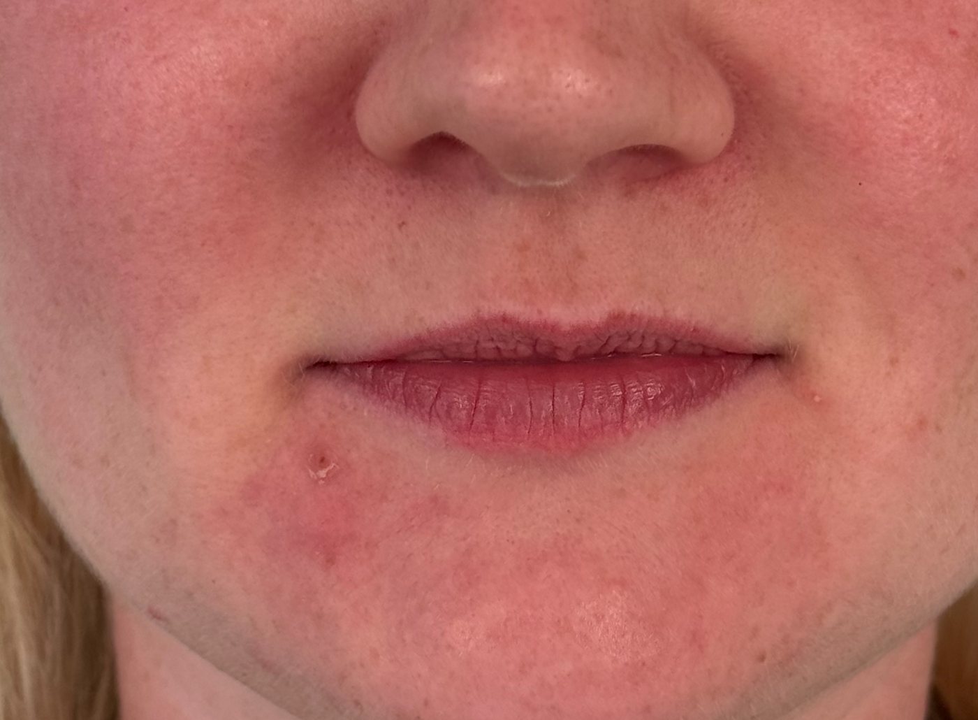 Before treatment