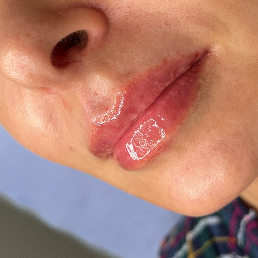 Lip enhancement, after treatment