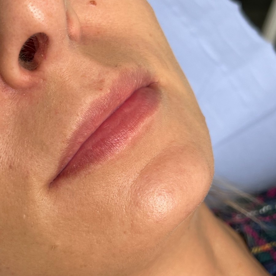 Lip enhancement, before treatment