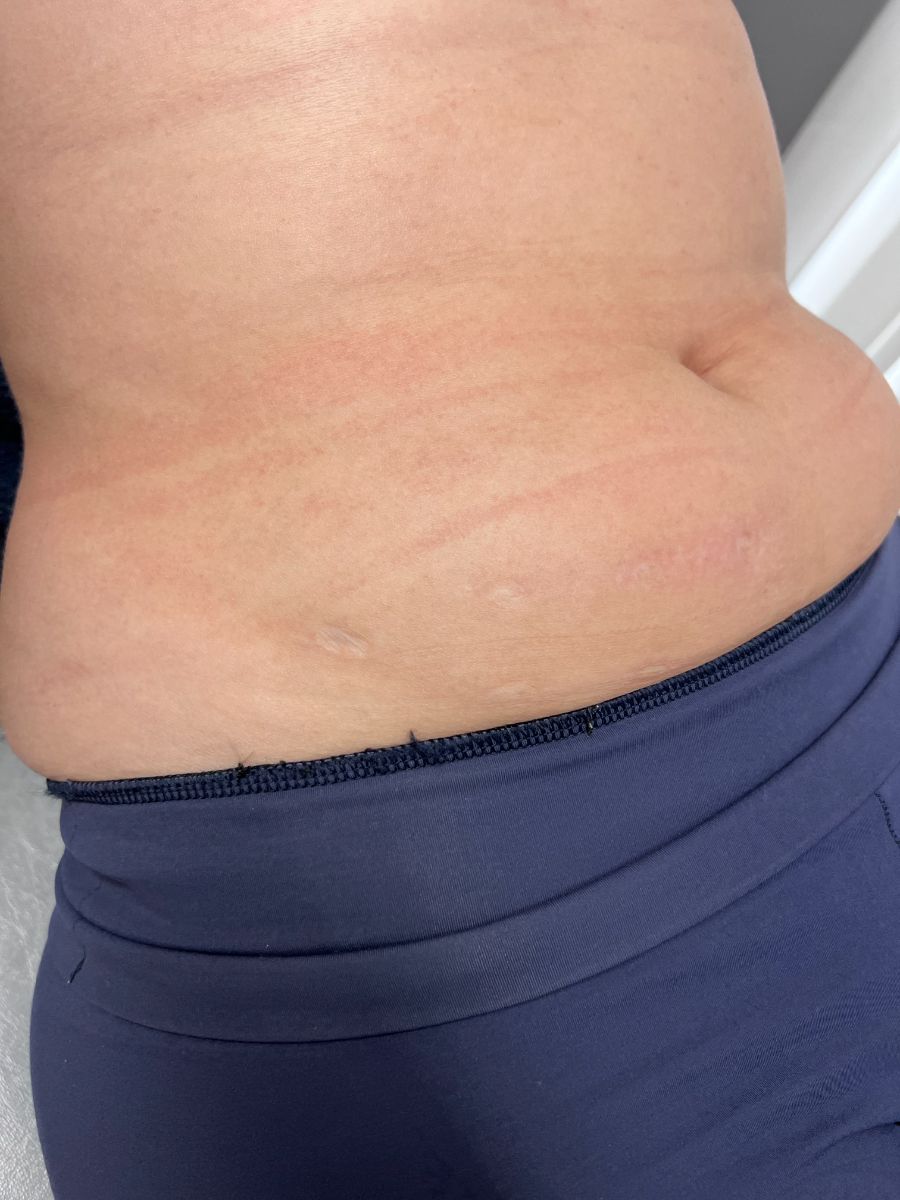 Microneedling · one session — after (rotated 90° anticlockwise, display only)