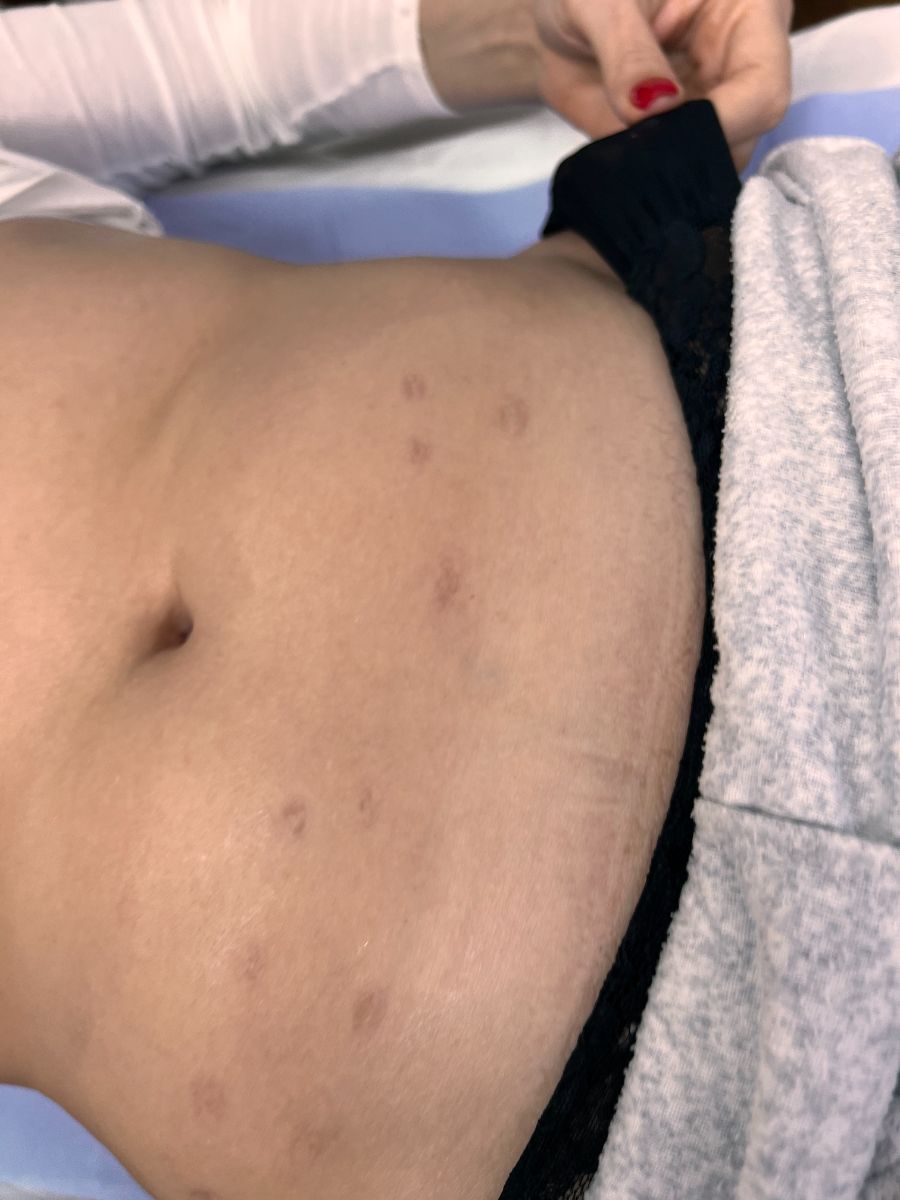 Microneedling · one session — before