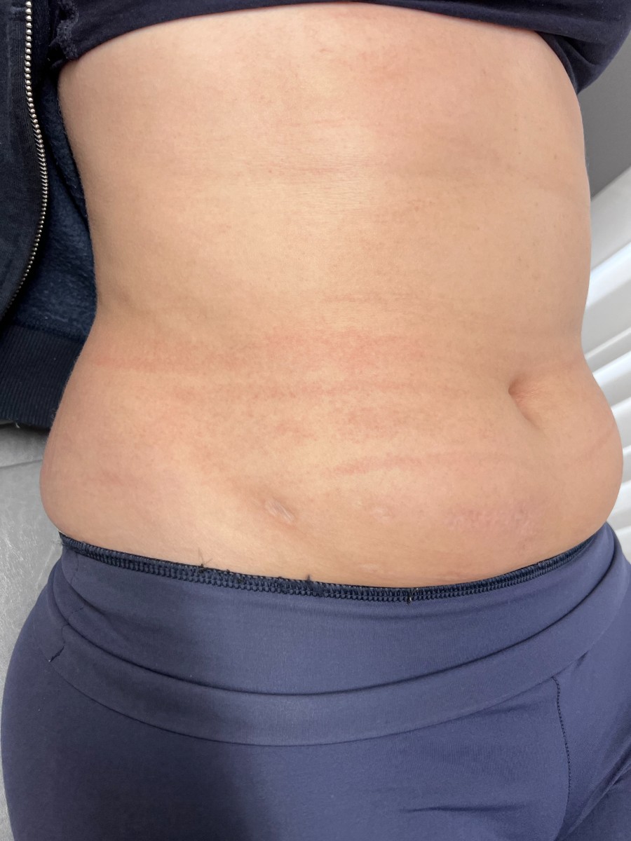Microneedling · abdomen · after, 4 May 2022