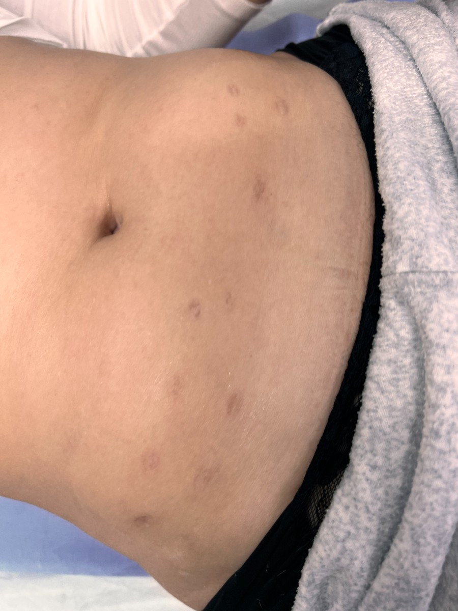 Microneedling · abdomen · before, 9 February 2022