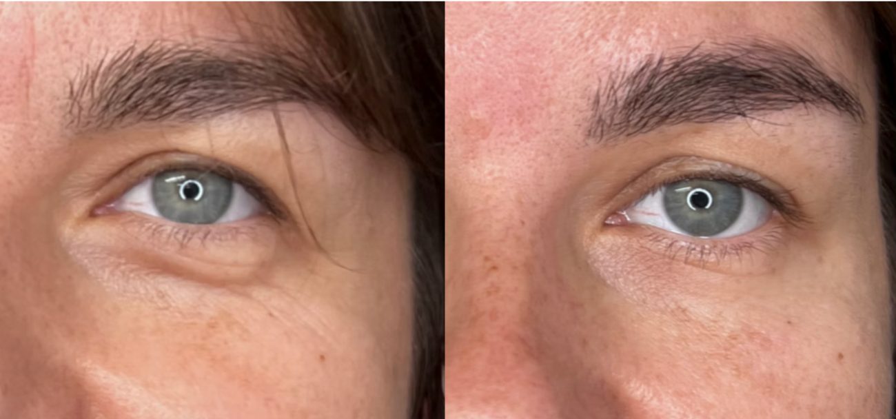 Before-and-after result &mdash; bulkier to slimmer, before