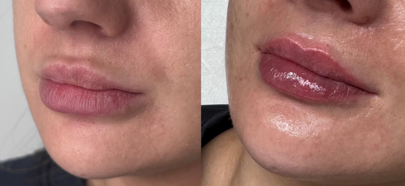 Lip enhancement result, before