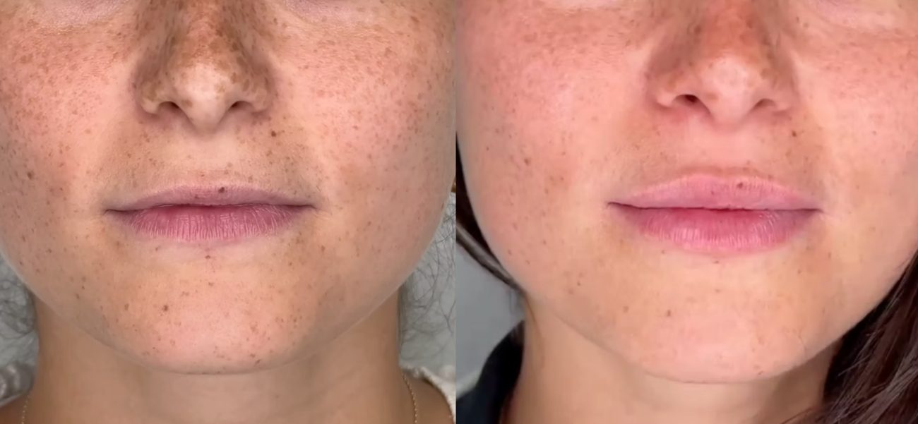 Lip enhancement result, before