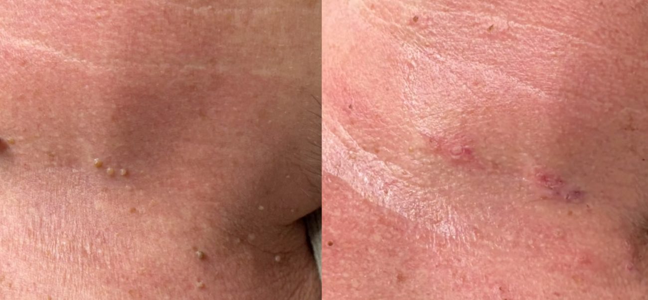 Skin-tag removal &mdash; before