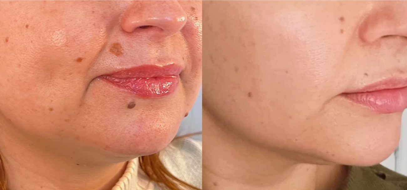 TCA peel result, before
