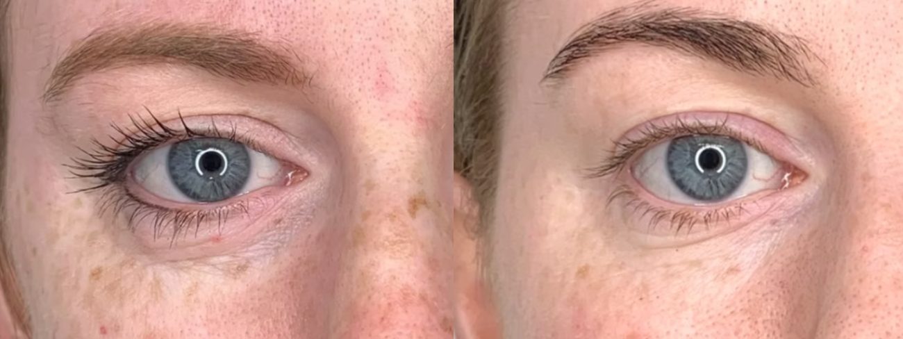 Under-eye area result, before