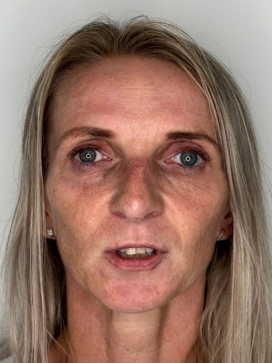 Before treatment