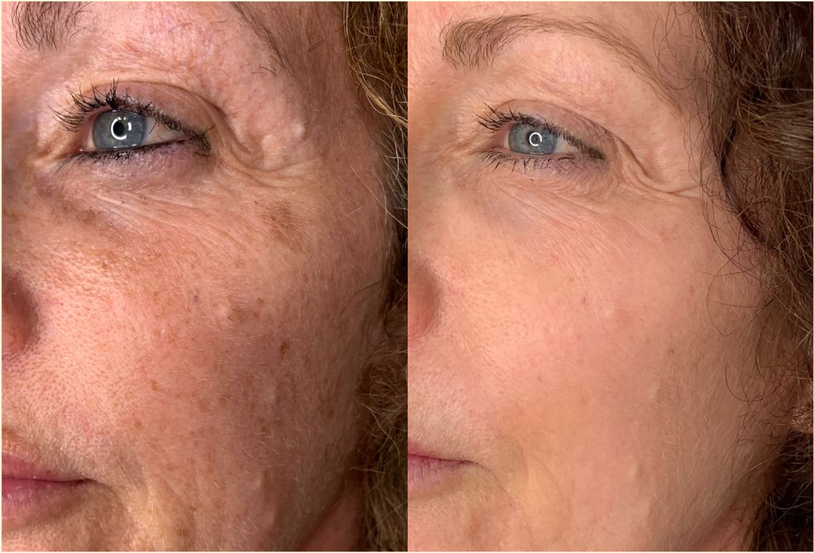 Pigmentation & tone &mdash; before treatment