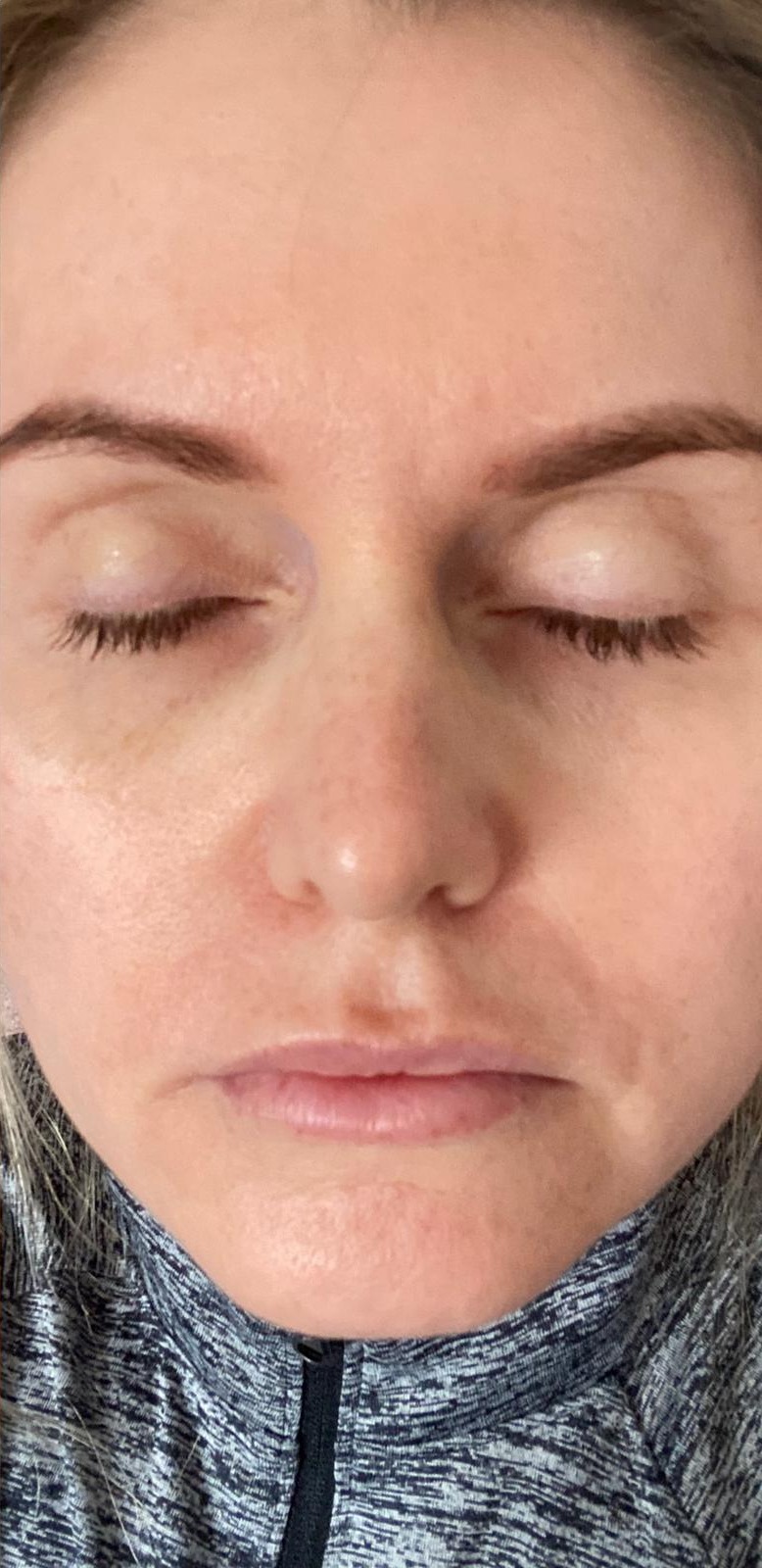 TCA peel result, after treatment