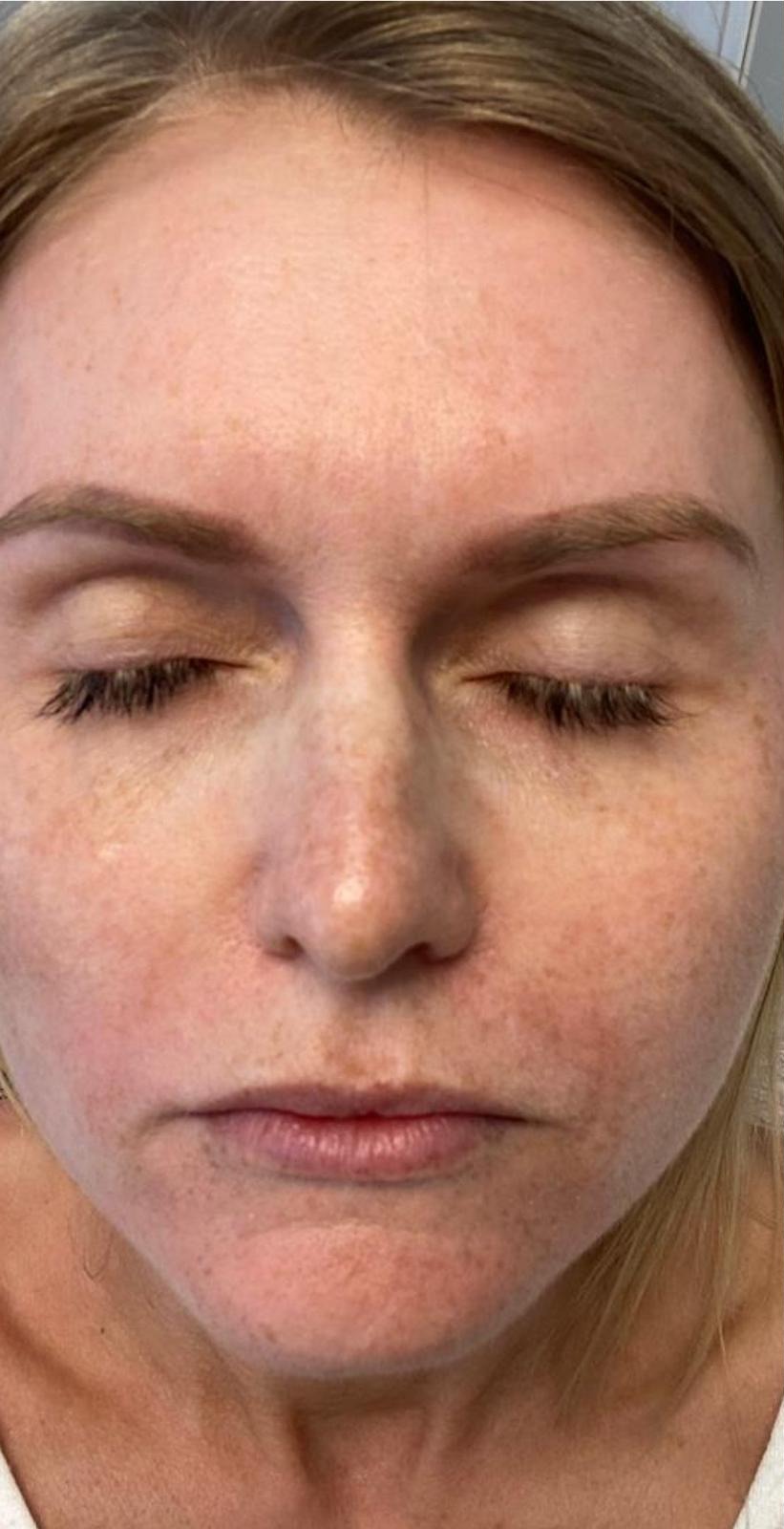 TCA peel result, before treatment