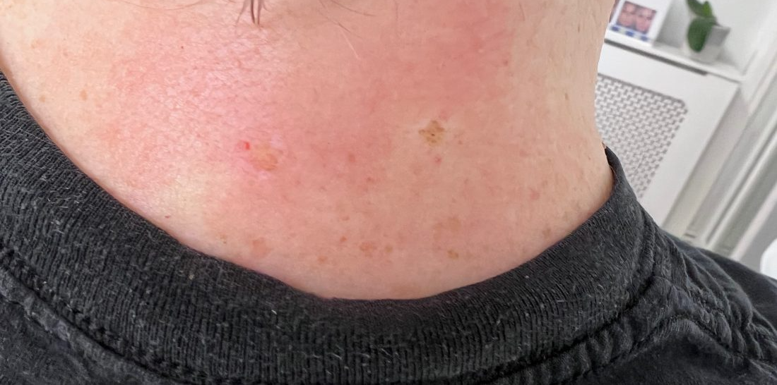 After treatment