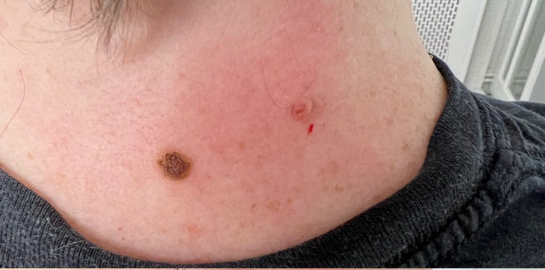 Before treatment
