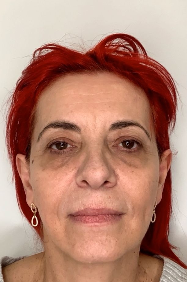 Before-and-after result