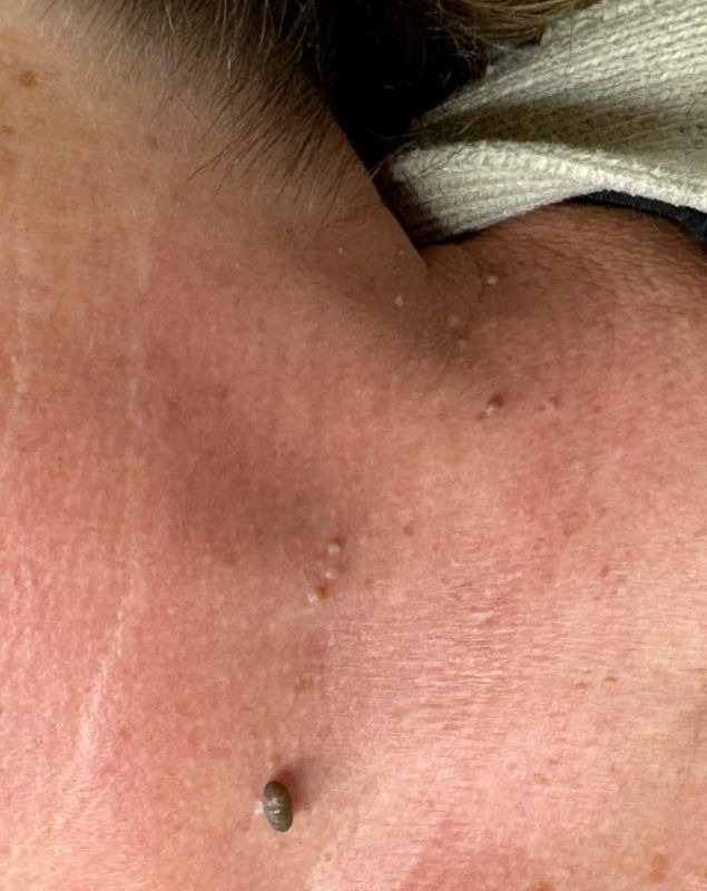 Before treatment