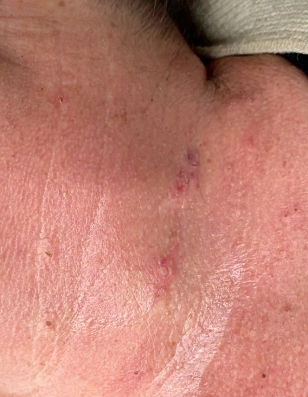 After treatment