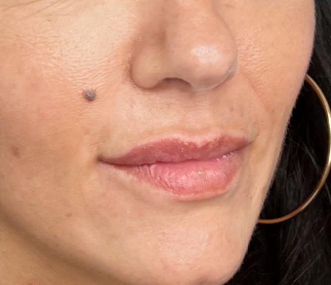 Lip enhancement, after treatment &mdash; lower-face view