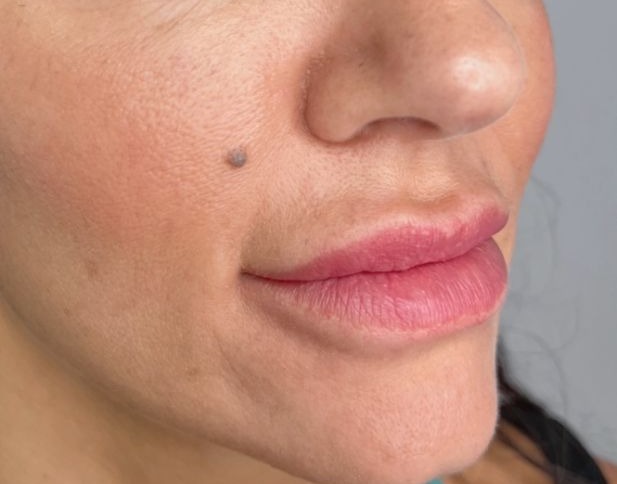Lip enhancement, before treatment &mdash; lower-face view
