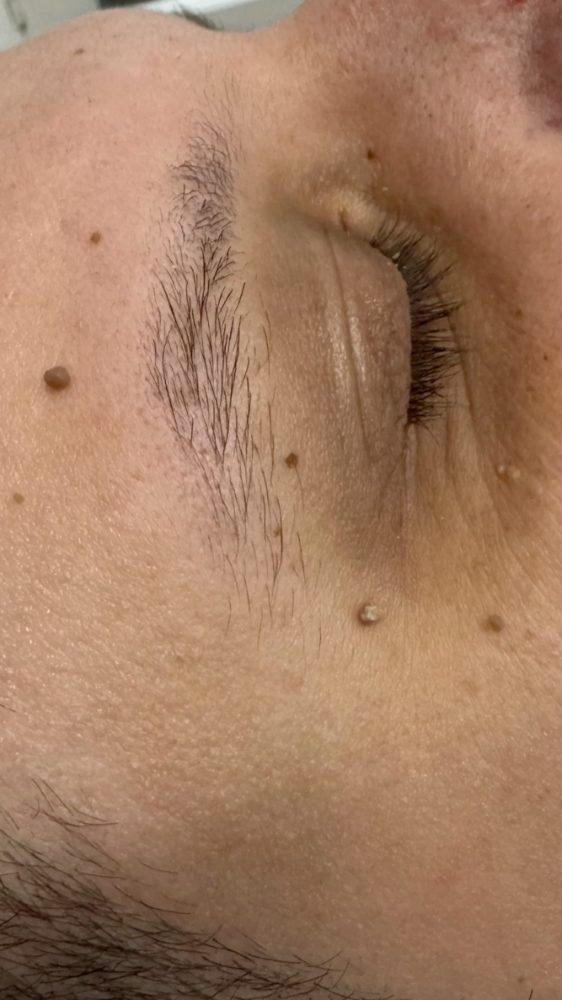 Before treatment
