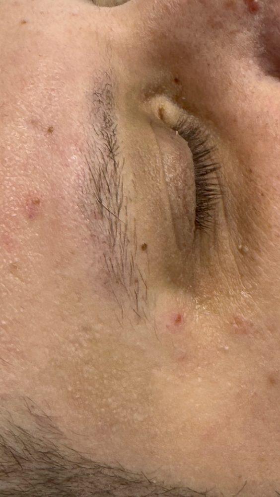 After treatment