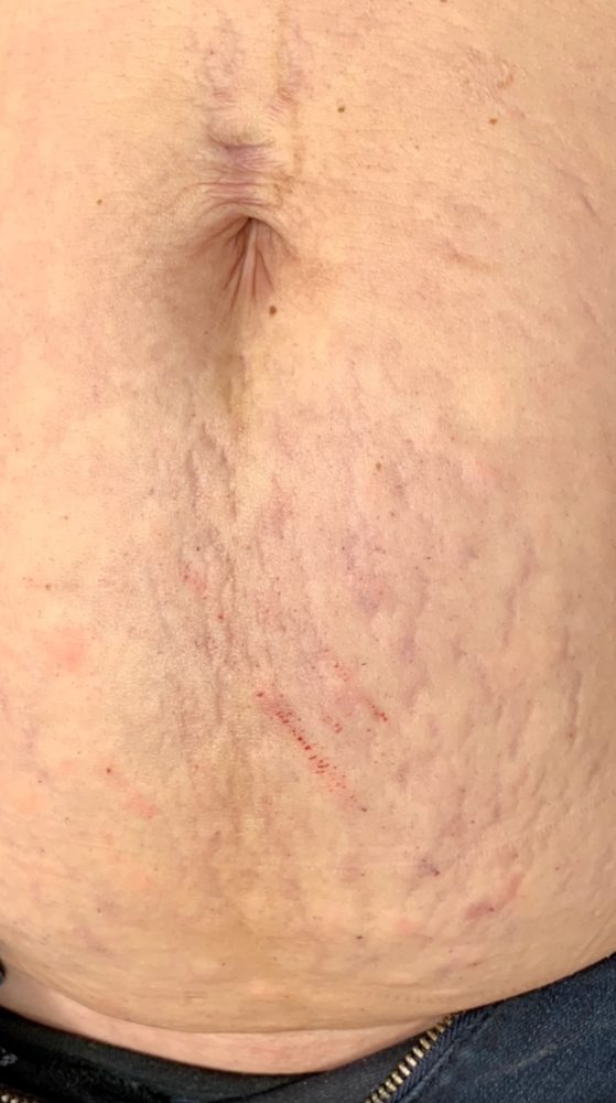 Before treatment