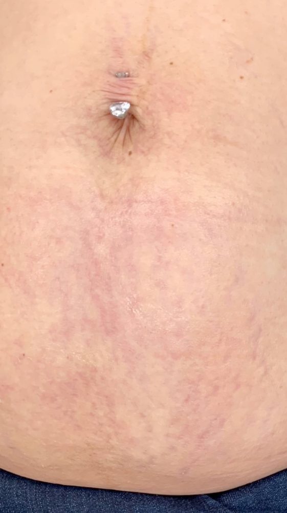 After treatment