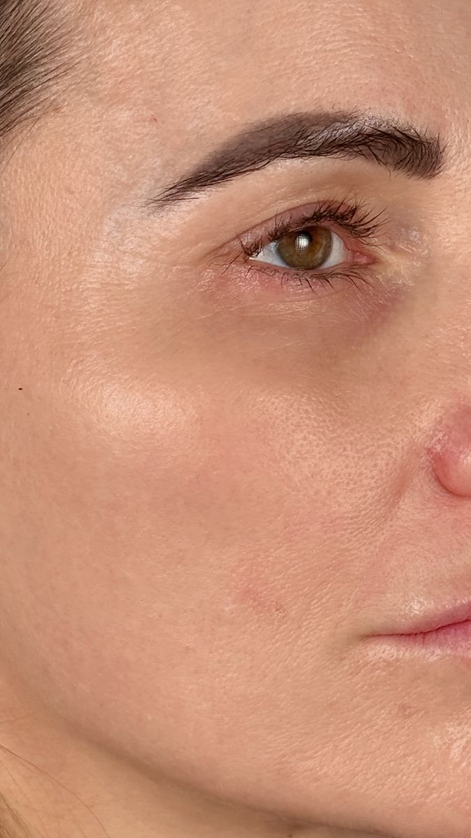 Recovered gallery image skin-quality-after.png &mdash; Skin quality & texture (after)