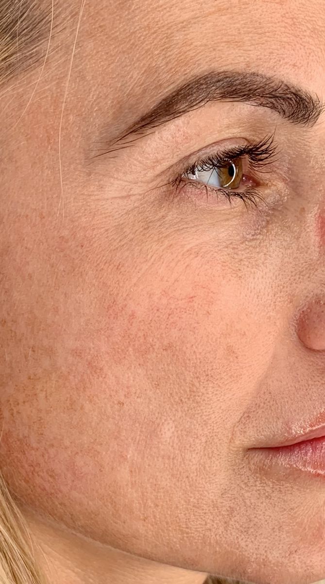 Recovered gallery image skin-quality-before.png &mdash; Skin quality & texture (before)